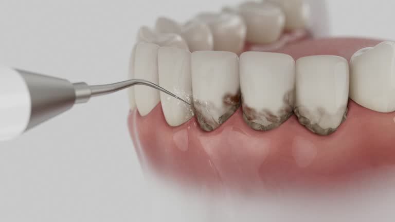 Trusted Wisdom Tooth Removal service in Stanhope, NJ - Dentist Open Now
